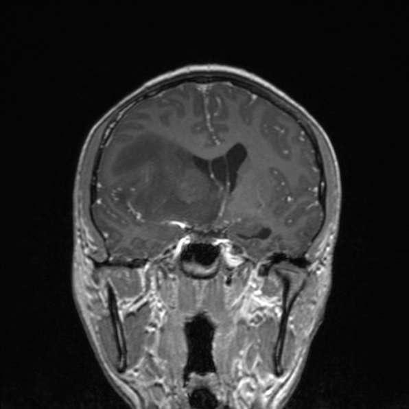 Cerebral abscess (Radiopaedia 24212-24478 Coronal T1 C+ 100).jpg