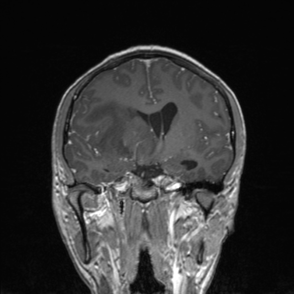 Cerebral abscess (Radiopaedia 24212-24478 Coronal T1 C+ 104).jpg