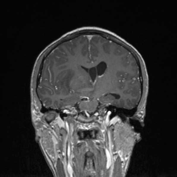Cerebral abscess (Radiopaedia 24212-24478 Coronal T1 C+ 110).jpg