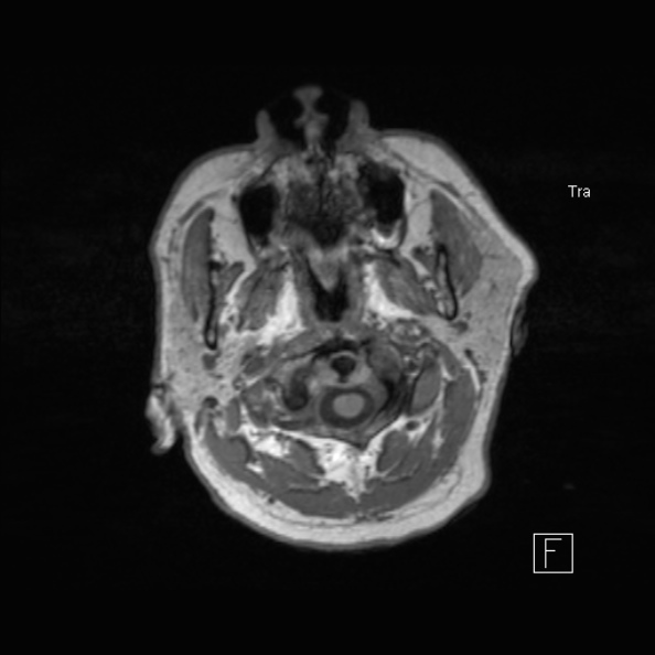 Cerebral abscess (Radiopaedia 26111-26247 Axial T1 10).jpg