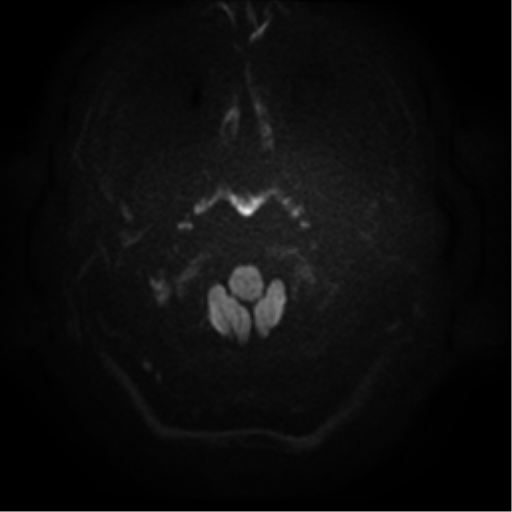 File:Cerebral abscess (Radiopaedia 57774-64740 Axial DWI 1).png