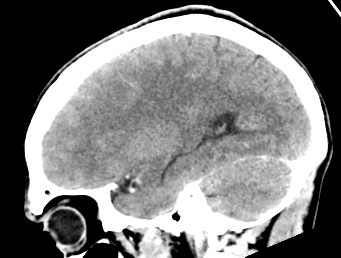 Cerebral abscess (Radiopaedia 60342-68008 Sagittal C+ delayed 16).png