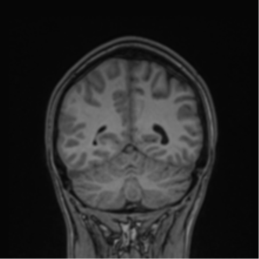 Cerebral abscess (Radiopaedia 60342-68009 Coronal T1 10).png