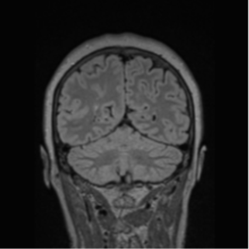 Cerebral abscess from pulmonary arteriovenous malformation (Radiopaedia 86275-102291 Coronal FLAIR 26).png