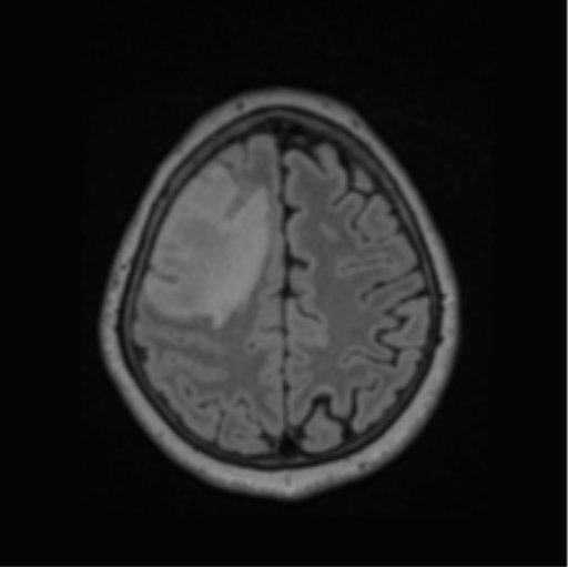 File:Cerebral abscess from pulmonary arteriovenous malformation (Radiopaedia 86275-102291 J 58).png