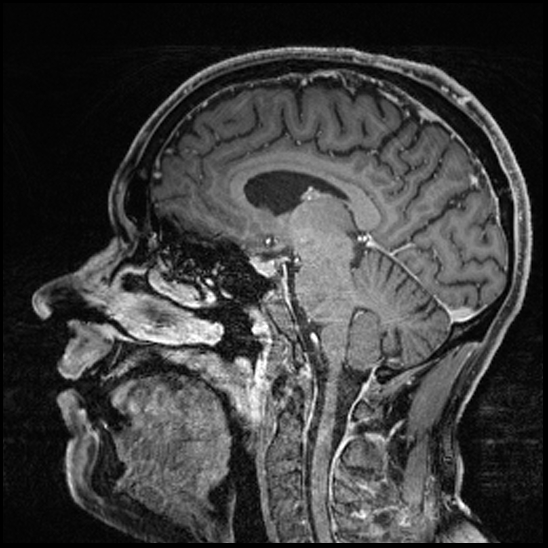 Cerebral abscess with ventriculitis (Radiopaedia 78965-91878 Sagittal T1 C+ 99).jpg