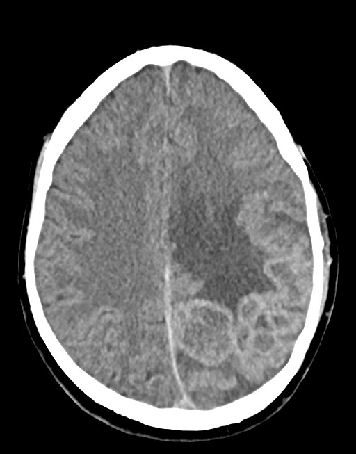 Cerebral abscesses (Radiopaedia 70458-80568 Axial non-contrast 41).jpg