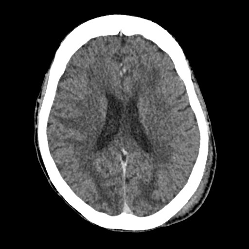 File:Cerebral amyloid angiopathy-related inflammation (Radiopaedia 74836-85848 Axial non-contrast 38).jpg