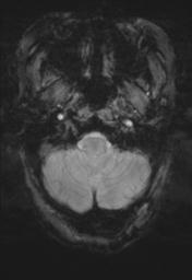File:Cerebral amyloid angiopathy (Radiopaedia 29129-29518 Axial SWI Magnitude 4).jpg