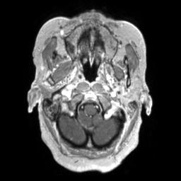 Cerebral amyloid angiopathy (Radiopaedia 29129-29518 Axial T1 C+ 21).jpg