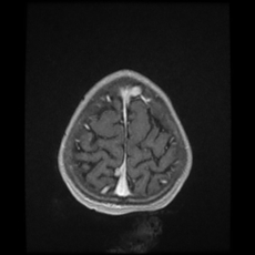Cerebral and spinal tuberculosis (Radiopaedia 90489-107837 Axial T1 C+ 171).jpg
