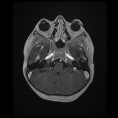 Cerebral and spinal tuberculosis (Radiopaedia 90489-107837 Axial T1 C+ 55).jpg