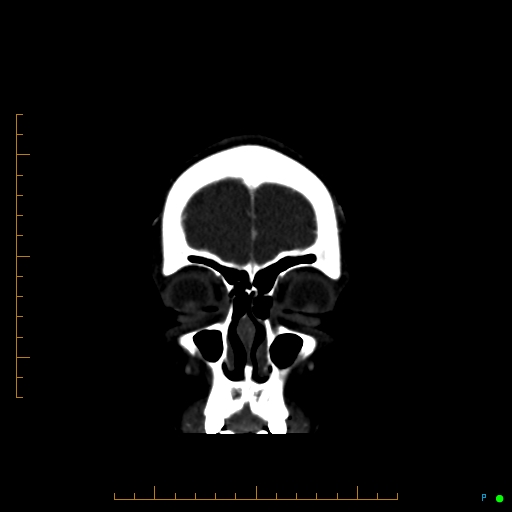 Cerebral arteriovenous malformation (AVM) (Radiopaedia 78162-90706 Coronal CTA 90).jpg