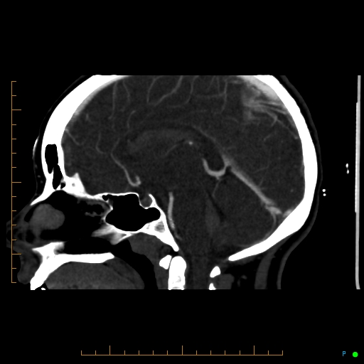 File:Cerebral arteriovenous malformation (AVM) (Radiopaedia 78162-90706 Sagittal CTA 41).jpg