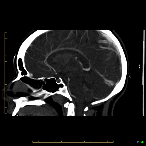 Cerebral arteriovenous malformation (AVM) (Radiopaedia 78162-90706 Sagittal CTA 42).jpg