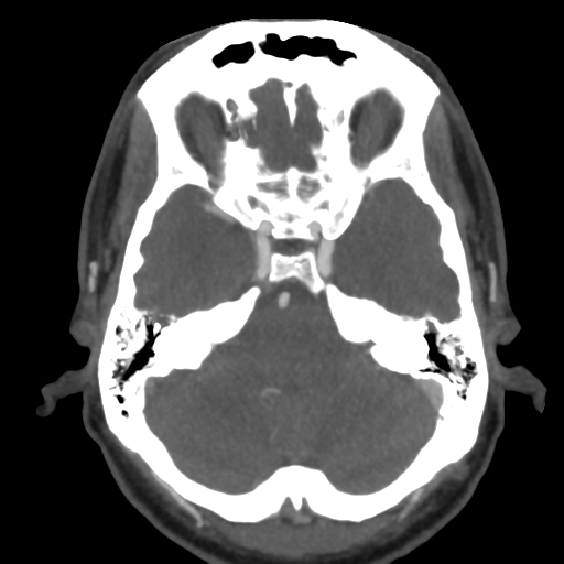 Cerebral arteriovenous malformation (Radiopaedia 39259-41505 AX CEREBRAL CTA 15).png