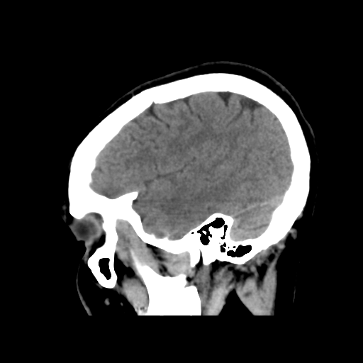 File:Cerebral arteriovenous malformation (Radiopaedia 39259-41505 B 28).png