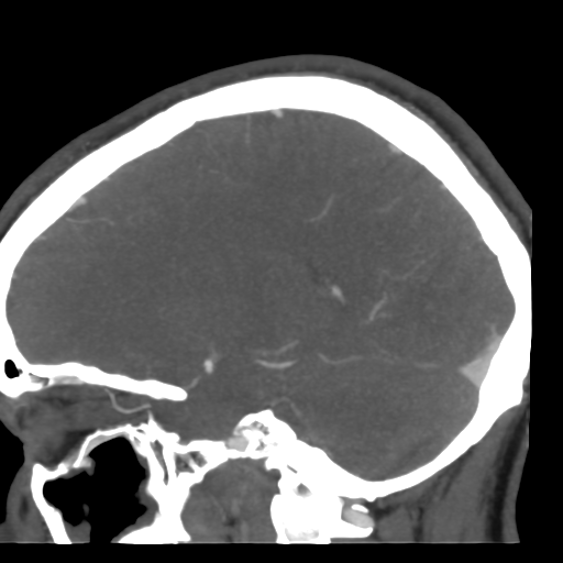 File:Cerebral arteriovenous malformation (Radiopaedia 39259-41505 Sagittal 39).png