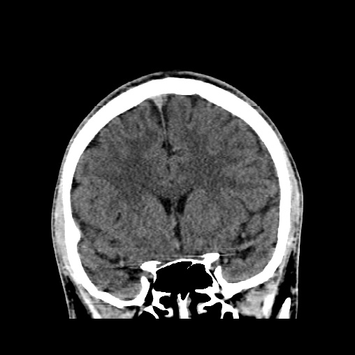 Cerebral arteriovenous malformation (Radiopaedia 61964-70028 Coronal non-contrast 22).jpg