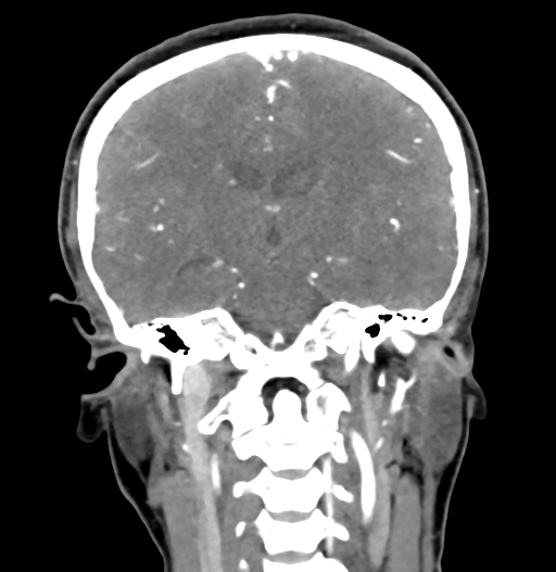File:Cerebral arteriovenous malformation (Radiopaedia 73830-84645 C 54).jpg