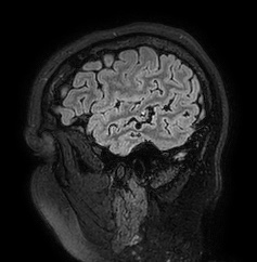 Cerebral arteriovenous malformation (Radiopaedia 74411-85654 Sagittal FLAIR 17).jpg