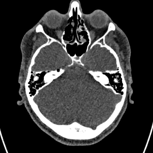 Cerebral arteriovenous malformation (Radiopaedia 78188-90746 Axial non-contrast 49).jpg
