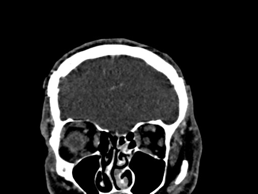 Cerebral arteriovenous malformation (Radiopaedia 78188-90746 Coronal C+ delayed 16).jpg