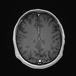 Cerebral arteriovenous malformation (Radiopaedia 84015-99245 Axial T1 C+ 108).jpg