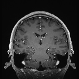 Cerebral arteriovenous malformation (Radiopaedia 84015-99245 Coronal T1 C+ 89).jpg