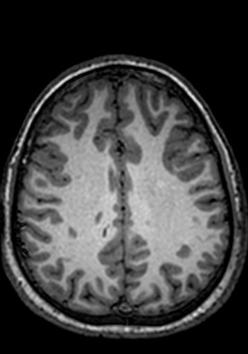 Cerebral arteriovenous malformation at posterior body of corpus callosum (Radiopaedia 74111-84925 Axial T1 86).jpg