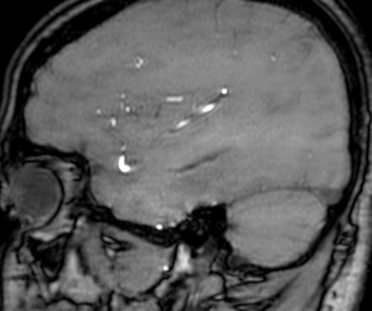 Cerebral arteriovenous malformation at posterior body of corpus callosum (Radiopaedia 74111-84925 J 304).jpg