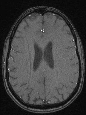Cerebral arteriovenous malformation with hemorrhage (Radiopaedia 34422-35737 Axial MRA 55).png