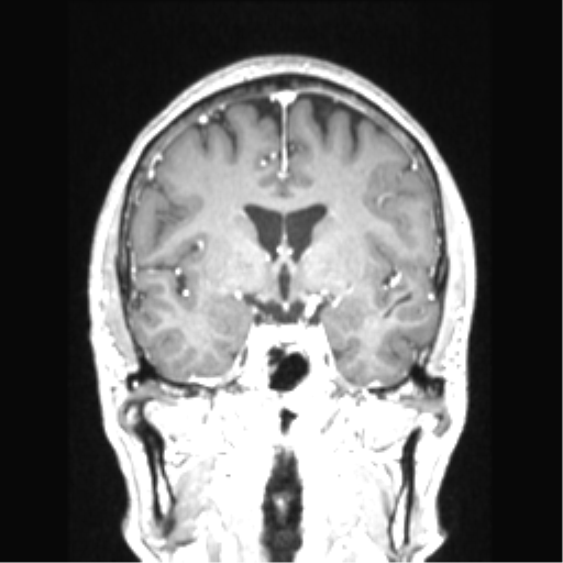 Cerebral arteriovenous malformation with hemorrhage (Radiopaedia 34422-35737 Coronal T1 C+ 54).png