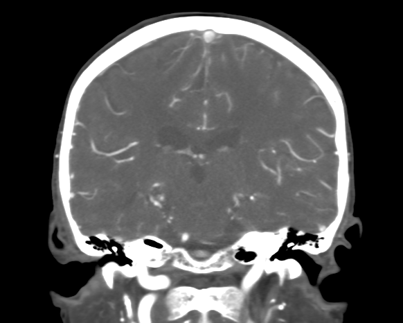 Cerebral arteriovenous malformation with lobar hemorrhage (Radiopaedia 44725-48511 A 34).png