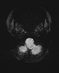 Cerebral cavernous venous malformation (Radiopaedia 70008-80021 Axial SWI 4).jpg