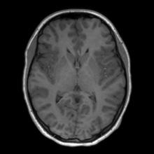 Cerebral cavernous venous malformation (Radiopaedia 70008-80021 Axial T1 38).jpg