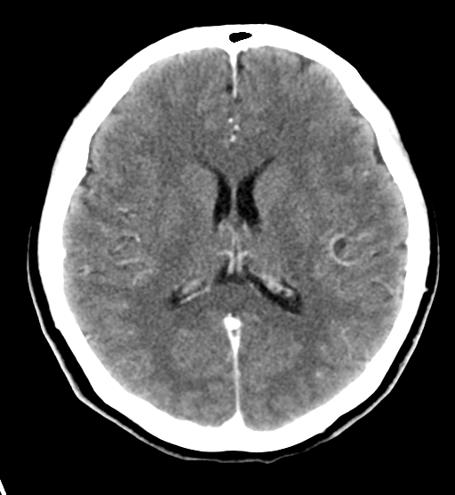 File:Cerebral cavernous venous malformations (Radiopaedia 48117-52945 Axial C+ delayed 20).png