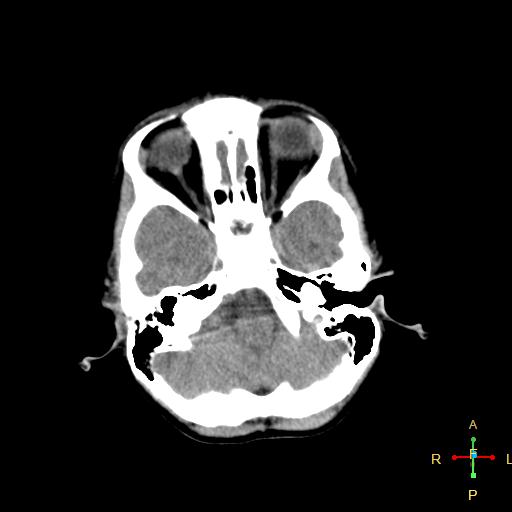 File:Cerebral contusion (Radiopaedia 48869-53911 Axial non-contrast 2).jpg