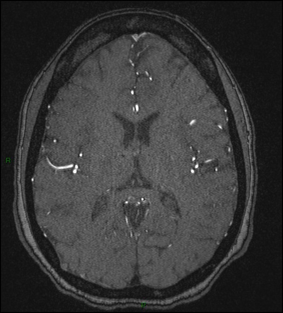 Cerebral fat embolism (Radiopaedia 35022-36525 Axial TOF 119).jpg