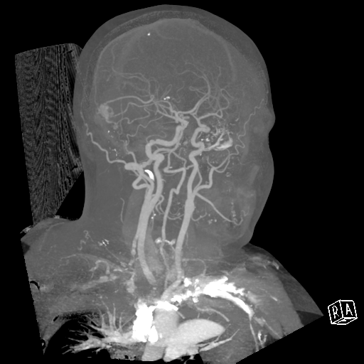 File:Cerebral hemorrhage secondary to arteriovenous malformation (Radiopaedia 33497-34571 A 24).png
