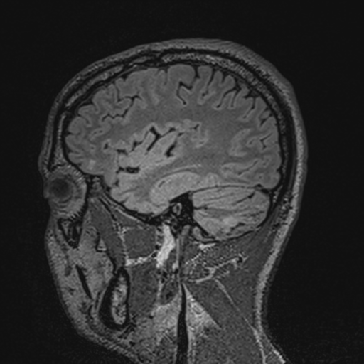 File:Cerebral hemorrhagic contusions- temporal evolution (Radiopaedia 40224-42757 Sagittal T1 22).png