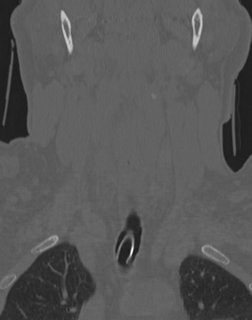 Cerebral hemorrhagic contusions and cervical spine fractures (Radiopaedia 32865-33841 Coronal bone window 16).jpg