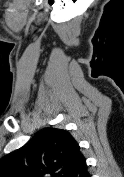 Cerebral hemorrhagic contusions and cervical spine fractures (Radiopaedia 32865-33841 G 21).jpg