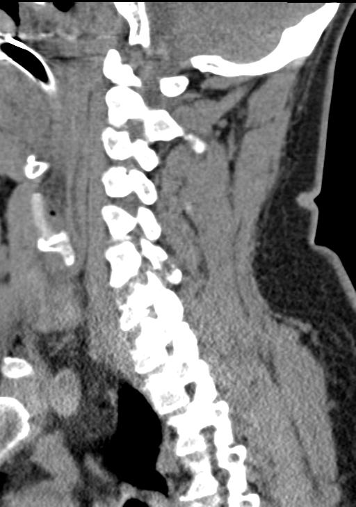 Cerebral hemorrhagic contusions and cervical spine fractures (Radiopaedia 32865-33841 G 67).jpg