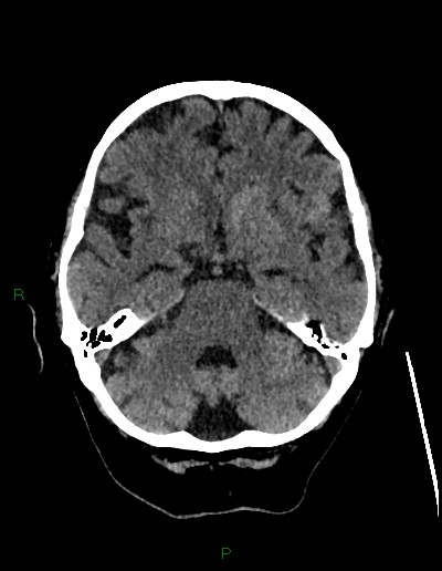 Cerebral metastases - ependymal and parenchymal (Radiopaedia 79877-93131 Axial non-contrast 22).jpg
