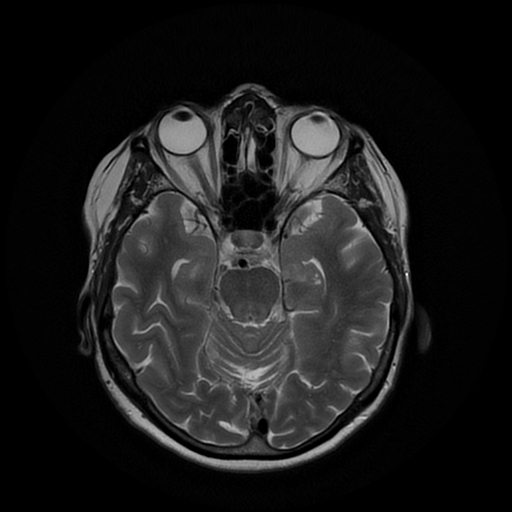 File:Cerebral metastases - melanoma (Radiopaedia 80972-94522 Axial T2 12).jpg