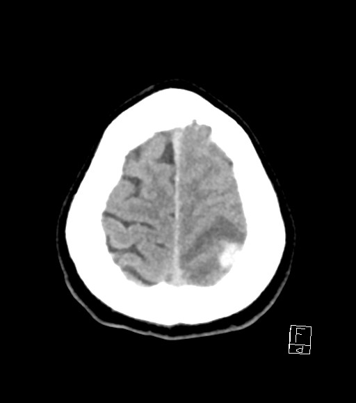 Cerebral metastases - testicular choriocarcinoma (Radiopaedia 84486-99855 Axial non-contrast 10).jpg