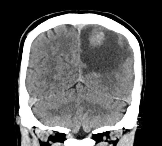 Cerebral metastases - testicular choriocarcinoma (Radiopaedia 84486-99855 Coronal C+ delayed 48).jpg