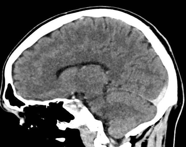 Cerebral metastases - testicular choriocarcinoma (Radiopaedia 84486-99855 F 34).jpg