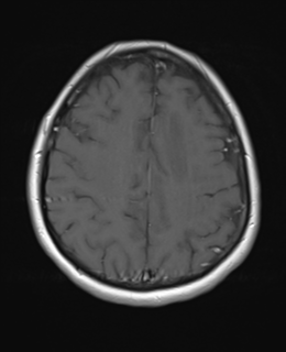 File:Cerebral metastases mimicking abscesses (Radiopaedia 45841-50131 Axial T1 C+ fat sat 21).png